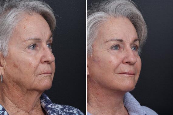 Deep Plane Facelift Before and After Photos in Princeton, NJ, Patient 21751