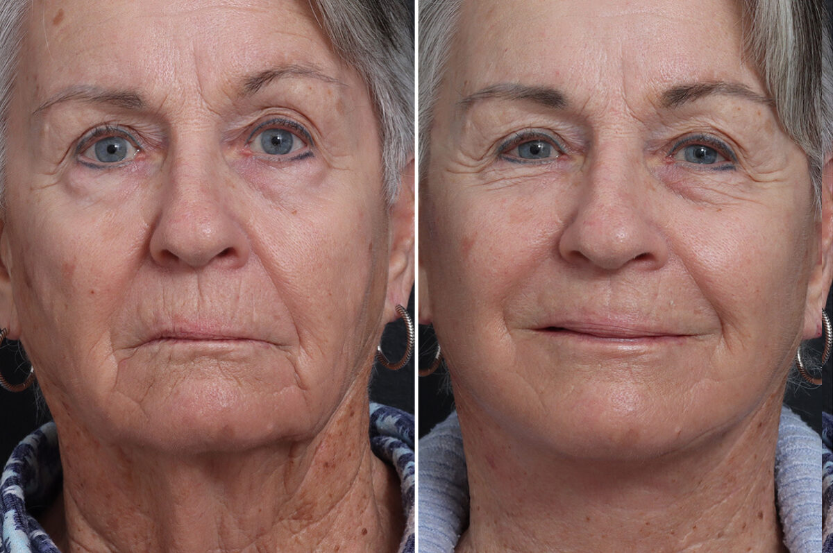 Deep Plane Facelift Before and After Photos in Princeton, NJ, Patient 21751
