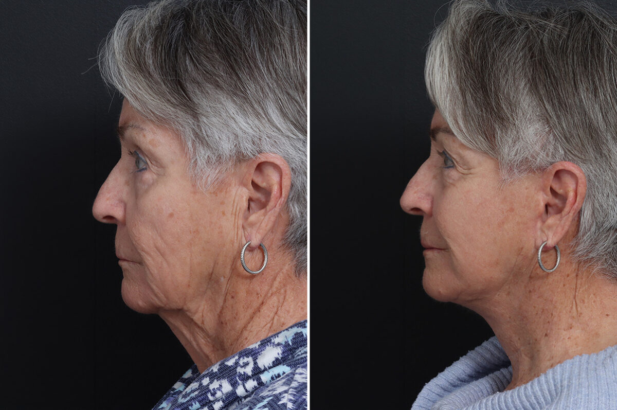 Deep Plane Facelift Before and After Photos in Princeton, NJ, Patient 21751