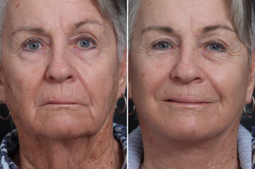 Deep Plane Facelift Before and After Photos in Princeton, NJ, Patient 21751