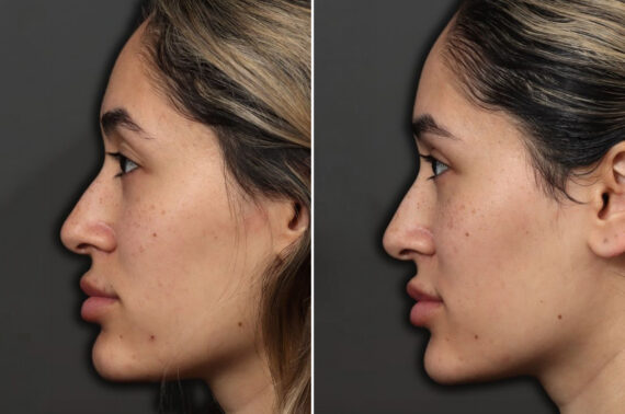 Upper Eyelid Surgery Before and After Photos in Princeton, NJ, Patient 21755