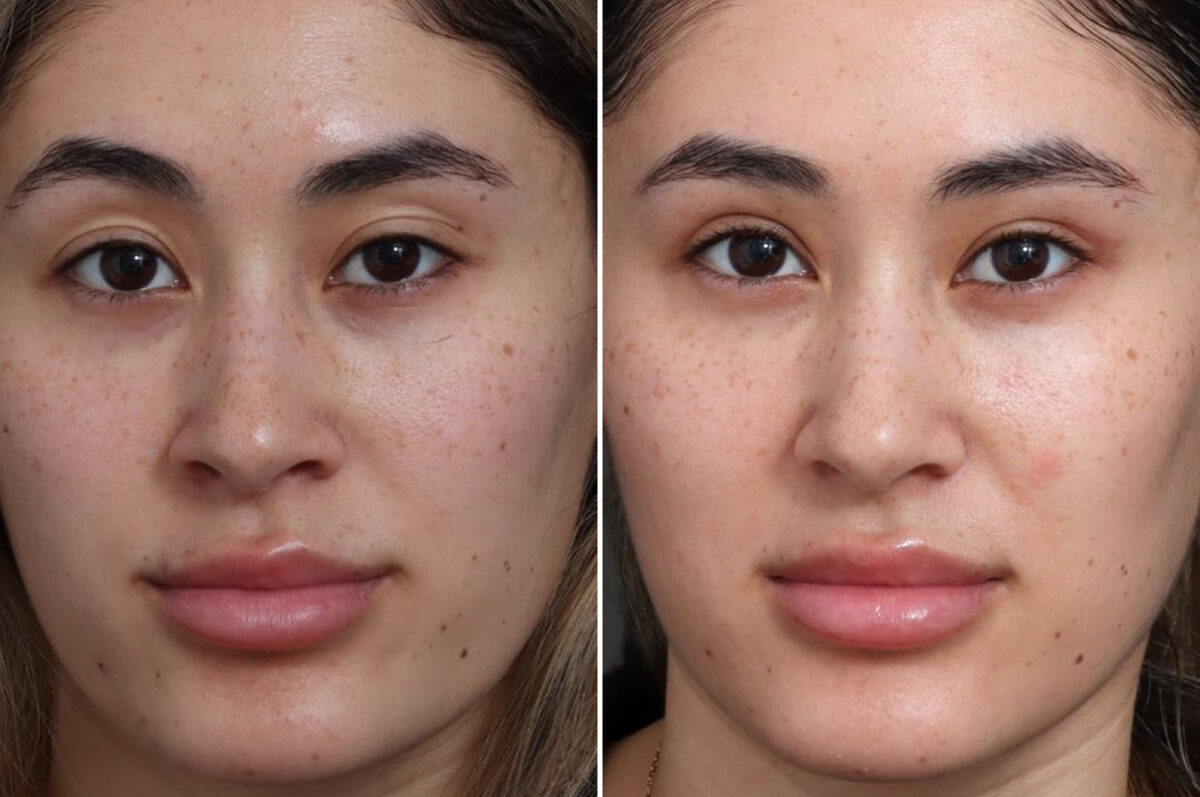 Upper Eyelid Surgery Before and After Photos in Princeton, NJ, Patient 21755