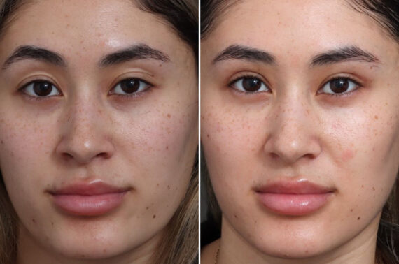 Upper Eyelid Surgery Before and After Photos in Princeton, NJ, Patient 21755