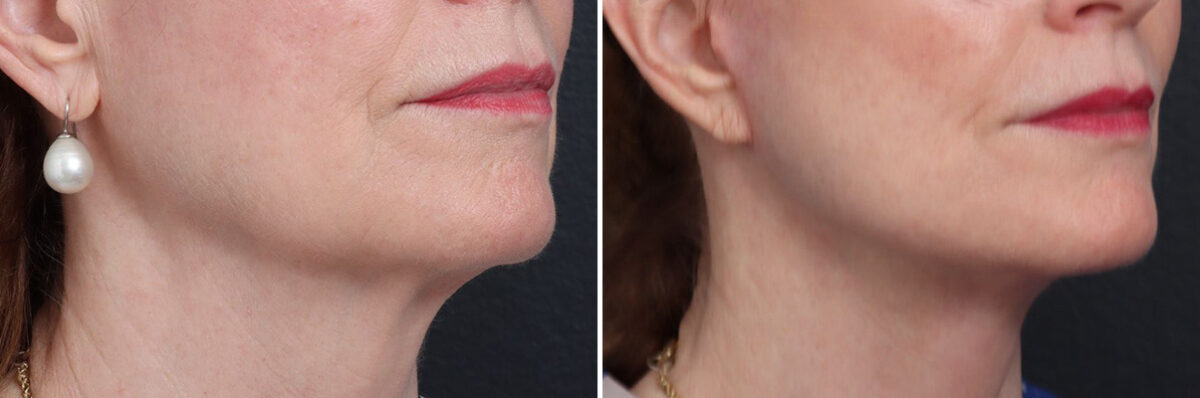 Facelift Before and After Photos in Princeton, NJ, Patient 21765