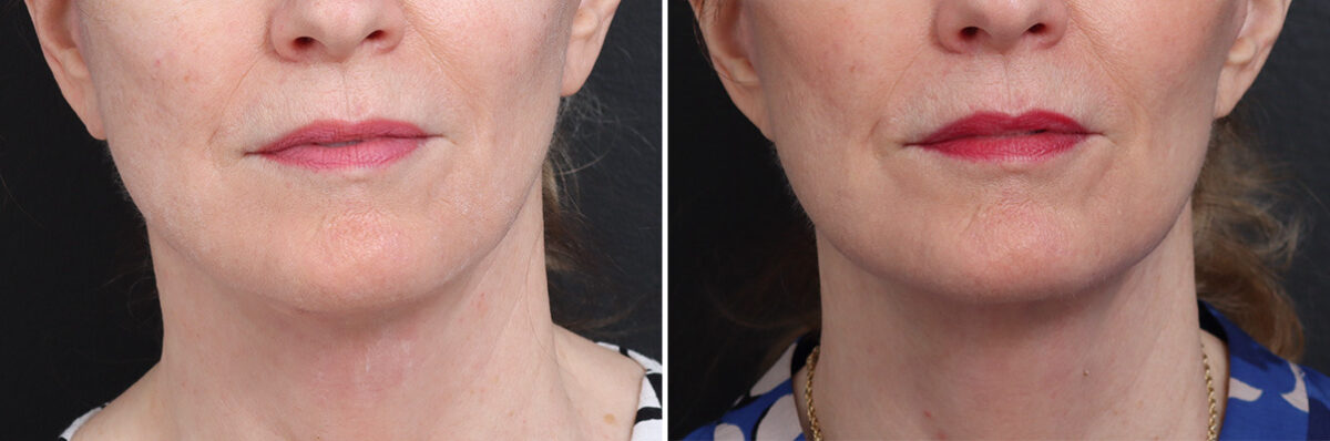 Facelift Before and After Photos in Princeton, NJ, Patient 21765