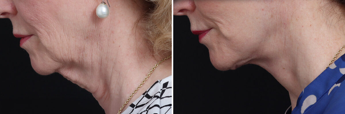 Facelift Before and After Photos in Princeton, NJ, Patient 21765