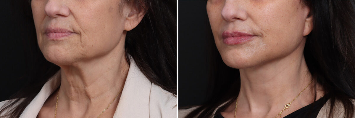 Deep Plane Facelift Before and After Photos in Princeton, NJ, Patient 21778