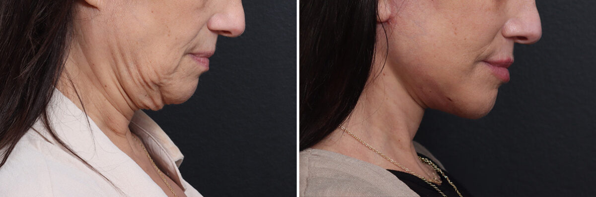 Deep Plane Facelift Before and After Photos in Princeton, NJ, Patient 21778