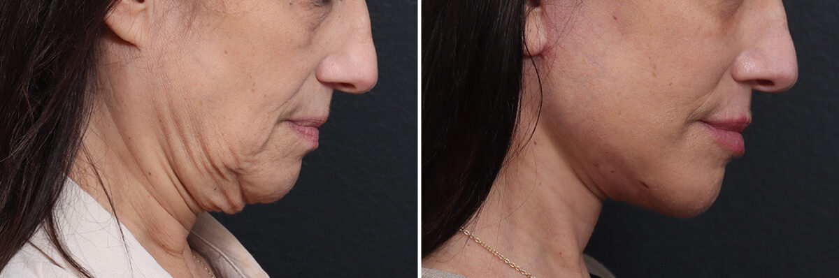 Deep Plane Facelift Before and After Photos in Princeton, NJ, Patient 21778