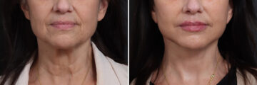 Deep Plane Facelift Before and After Photos in Princeton, NJ, Patient 21778