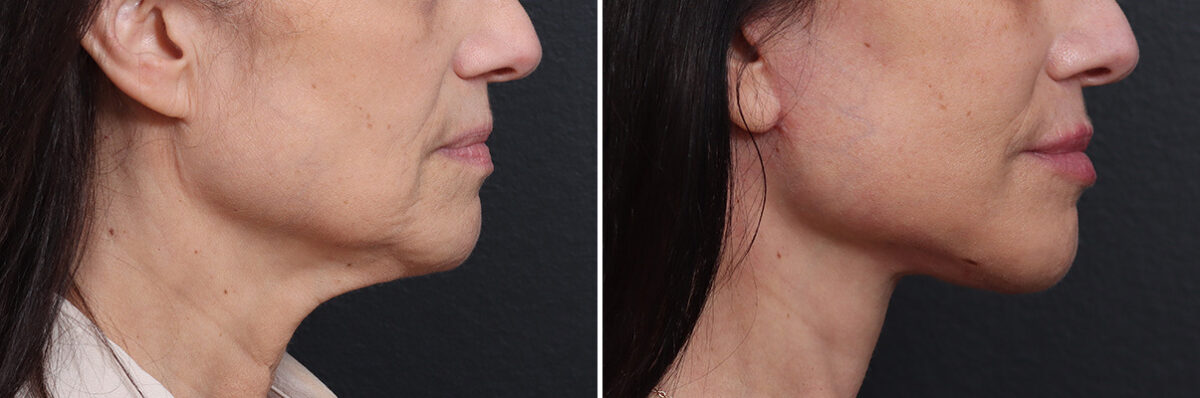 Deep Plane Facelift Before and After Photos in Princeton, NJ, Patient 21778