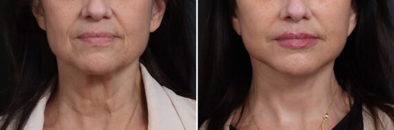 Deep Plane Facelift Before and After Photos in Princeton, NJ, Patient 21778