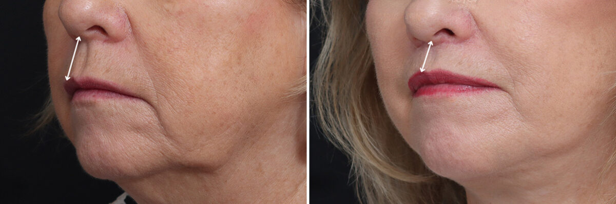 Lip Lift Before and After Photos in Princeton, NJ, Patient 21782