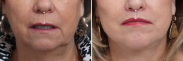 Lip Lift Before and After Photos in Princeton, NJ, Patient 21782