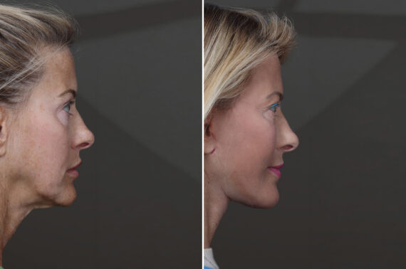 Deep Plane Facelift Before and After Photos in Princeton, NJ, Patient 21823