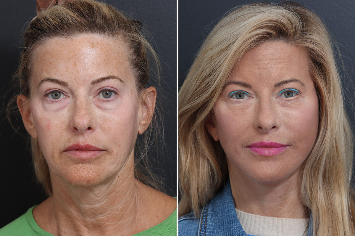 Deep Plane Facelift Before and After Photos in Princeton, NJ, Patient 21823