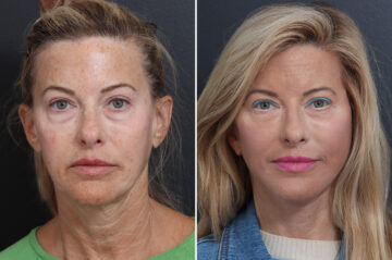 Deep Plane Facelift Before and After Photos in Princeton, NJ, Patient 21823