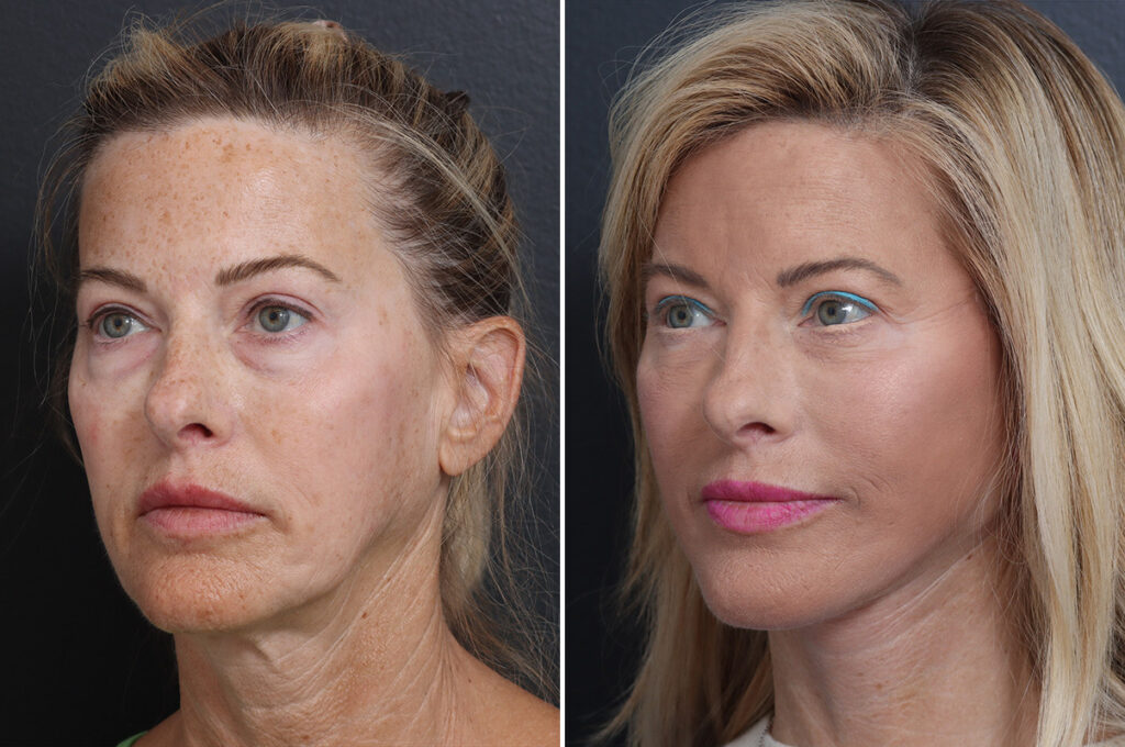 Facelift Patient before & after results