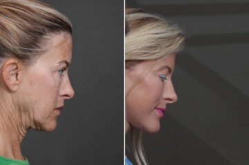 Deep Plane Facelift Before and After Photos in Princeton, NJ, Patient 21823