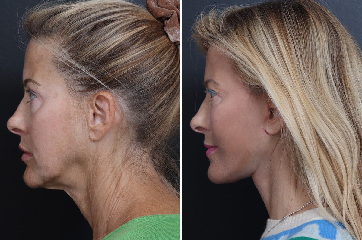 Deep Plane Facelift Before and After Photos in Princeton, NJ, Patient 21823