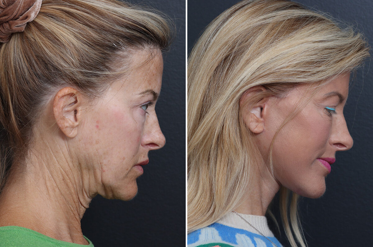 Deep Plane Facelift Before and After Photos in Princeton, NJ, Patient 21823