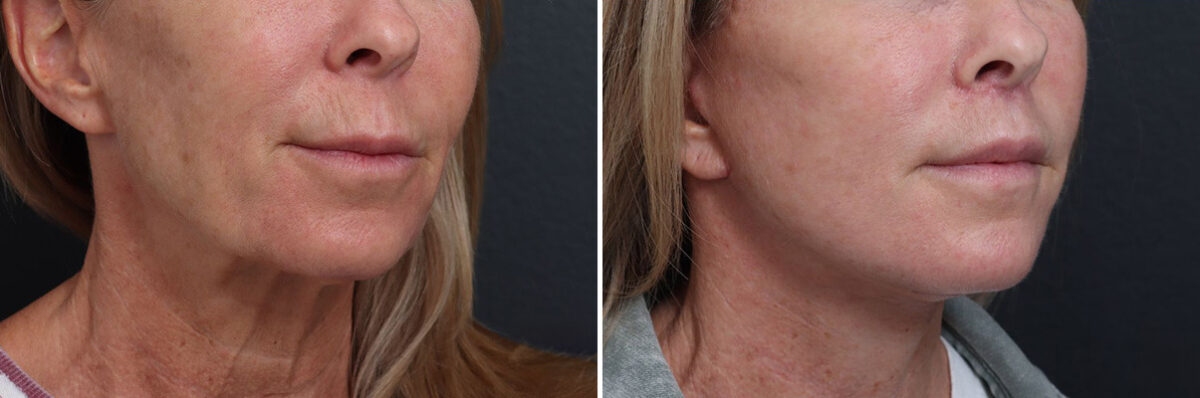 Facelift Before and After Photos in Princeton, NJ, Patient 21826