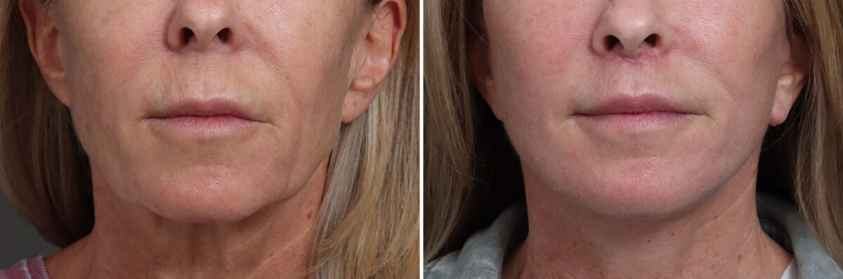 Facelift Before and After Photos in Princeton, NJ, Patient 21826
