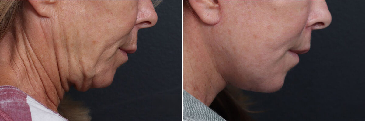 Facelift Before and After Photos in Princeton, NJ, Patient 21826