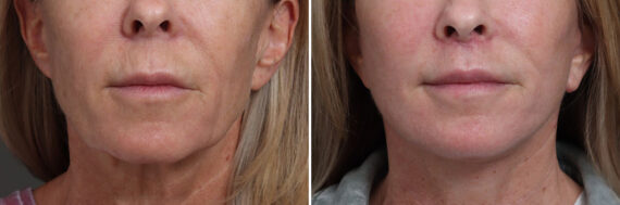 Facelift Before and After Photos in Princeton, NJ, Patient 21826