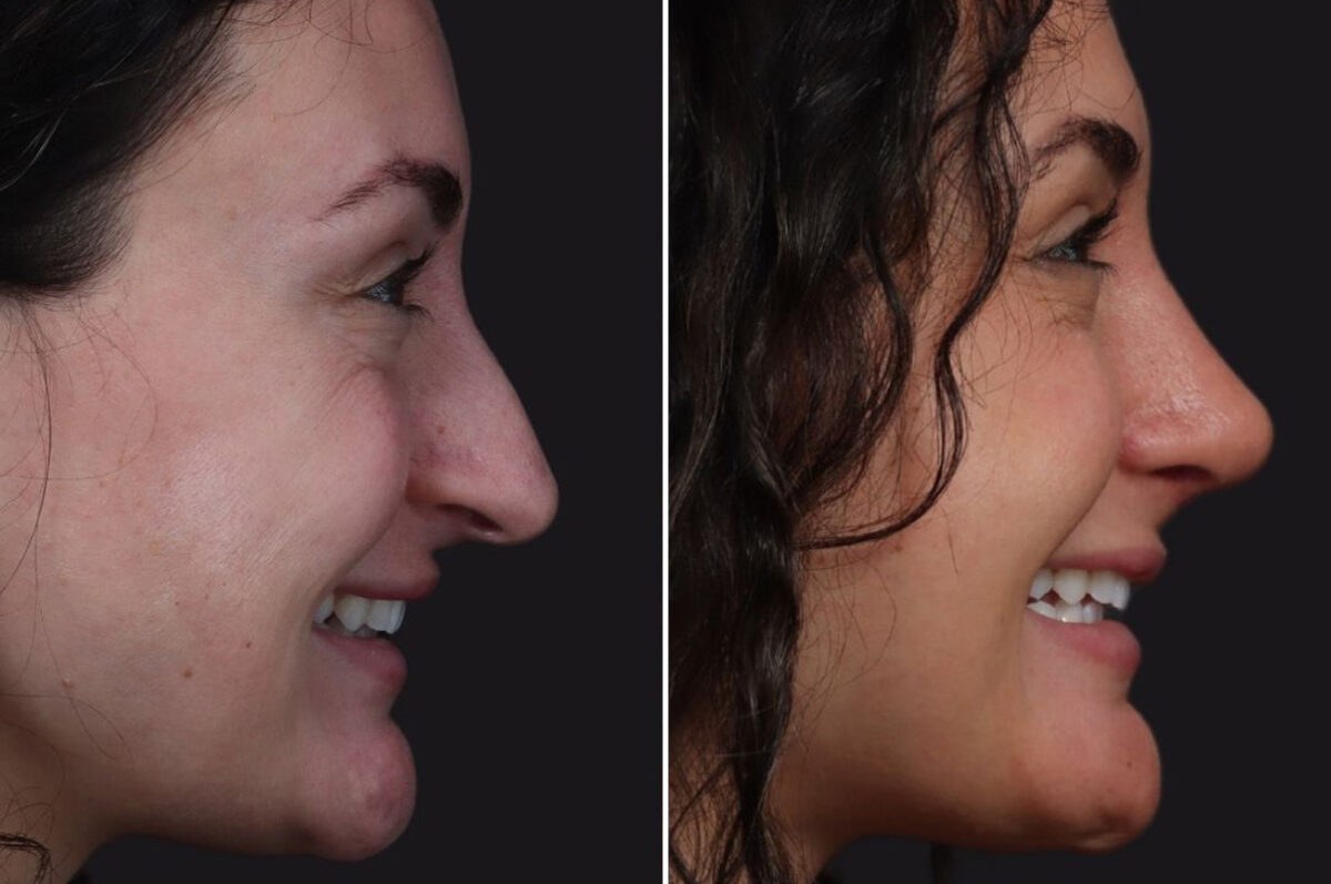 Rhinoplasty Before and After Photos in Princeton, NJ, Patient 21830