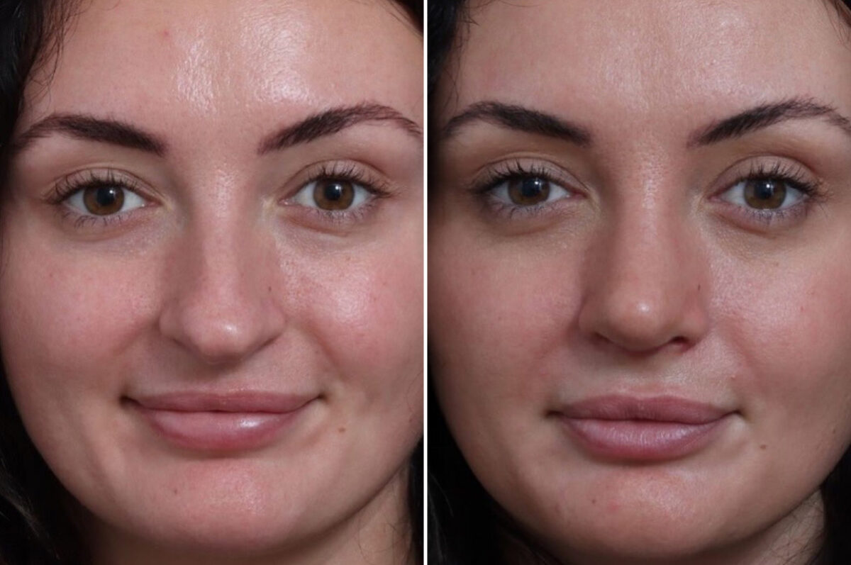 Rhinoplasty Before and After Photos in Princeton, NJ, Patient 21830