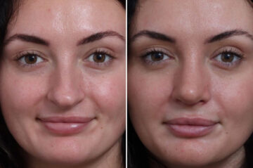 Rhinoplasty Before and After Photos in Princeton, NJ, Patient 21830