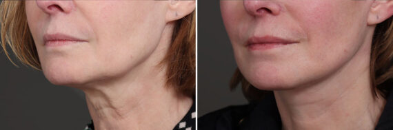 Facelift Before and After Photos in Princeton, NJ, Patient 21833