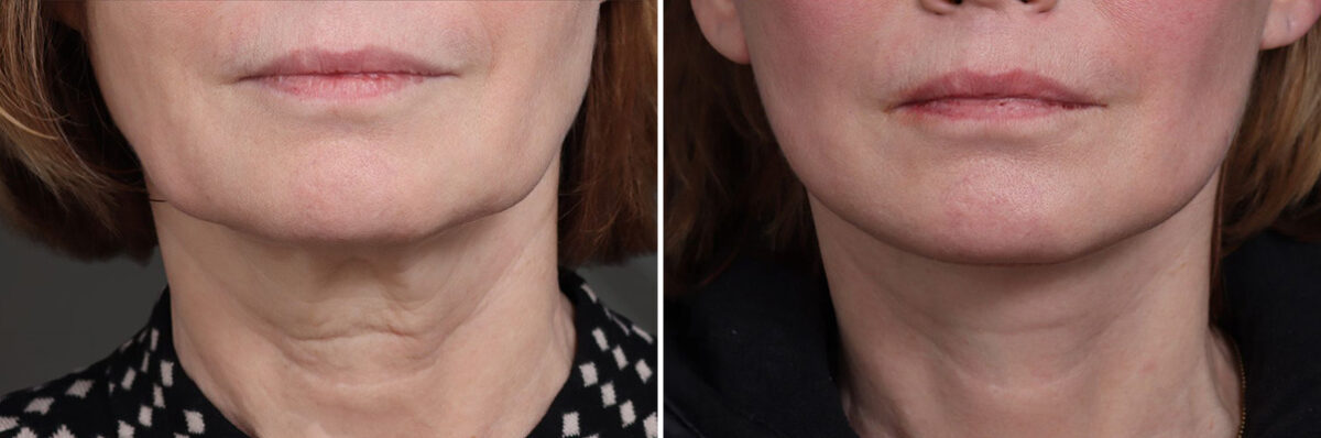 Facelift Before and After Photos in Princeton, NJ, Patient 21833