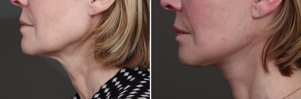 Facelift Before and After Photos in Princeton, NJ, Patient 21833