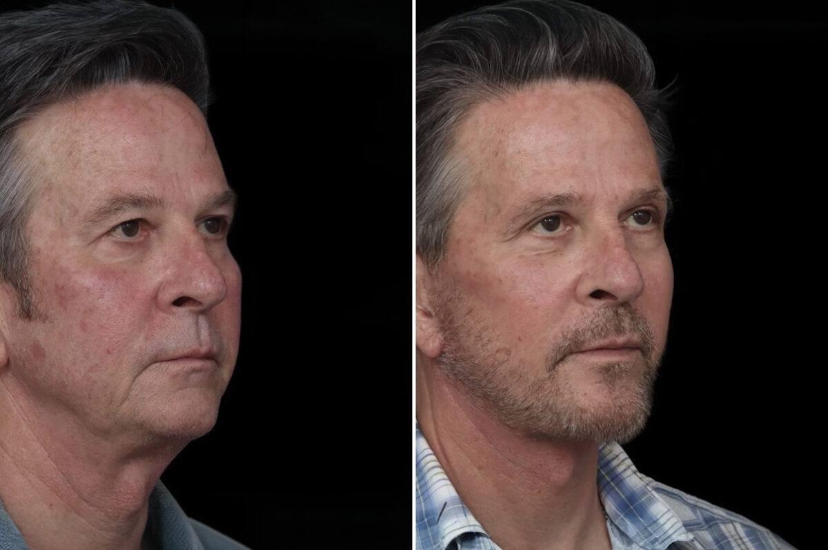 Chin Implants Before and After Photos in Princeton, NJ, Patient 21837