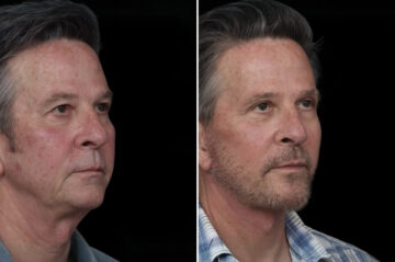 Deep Plane Facelift Before and After Photos in Princeton, NJ, Patient 21837