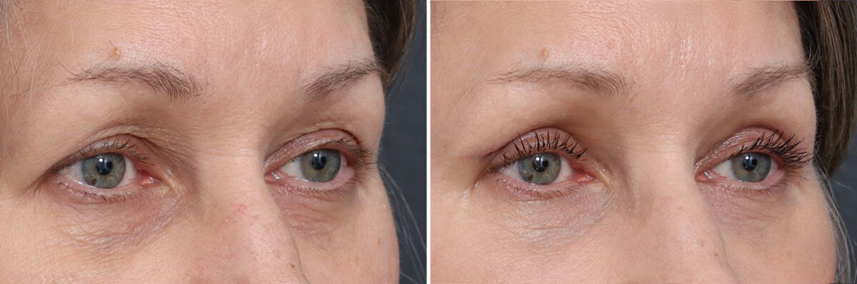 Upper Eyelid Surgery Before and After Photos in Princeton, NJ, Patient 21839