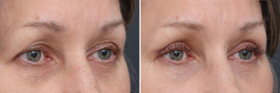 Upper Eyelid Surgery Before and After Photos in Princeton, NJ, Patient 21839