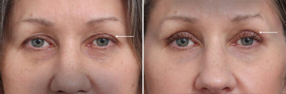 Upper Eyelid Surgery Before and After Photos in Princeton, NJ, Patient 21839