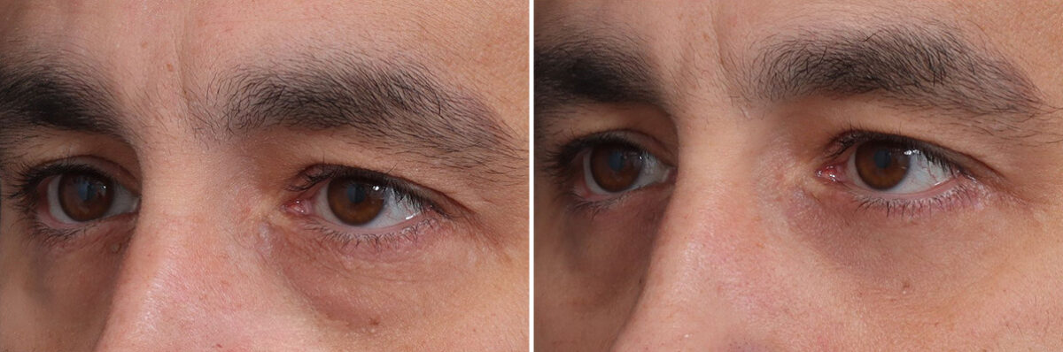 Fat Grafting Before and After Photos in Princeton, NJ, Patient 21842