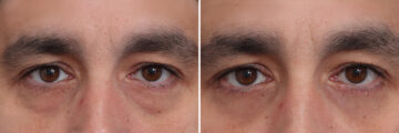 Fat Grafting Before and After Photos in Princeton, NJ, Patient 21842