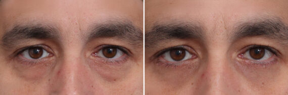 Fat Grafting Before and After Photos in Princeton, NJ, Patient 21842