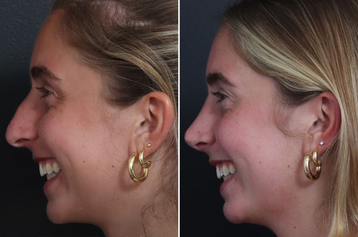 Rhinoplasty Before and After Photos in Princeton, NJ, Patient 21845