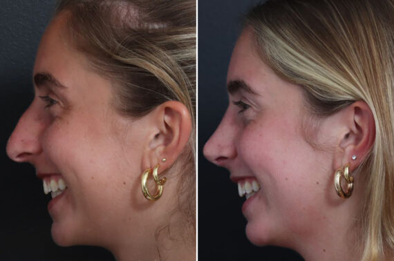 Rhinoplasty Before and After Photos in Princeton, NJ, Patient 21845