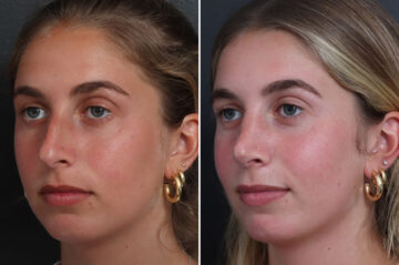 Rhinoplasty Before and After Photos in Princeton, NJ, Patient 21845