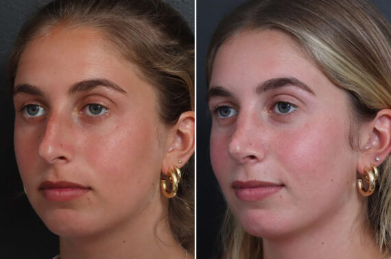 Rhinoplasty Before and After Photos in Princeton, NJ, Patient 21845