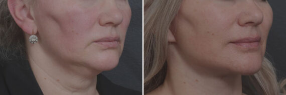 Deep Plane Facelift Before and After Photos in Princeton, NJ, Patient 22155