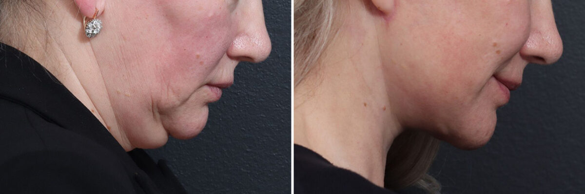 Deep Plane Facelift Before and After Photos in Princeton, NJ, Patient 22155