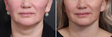 Deep Plane Facelift Before and After Photos in Princeton, NJ, Patient 22155